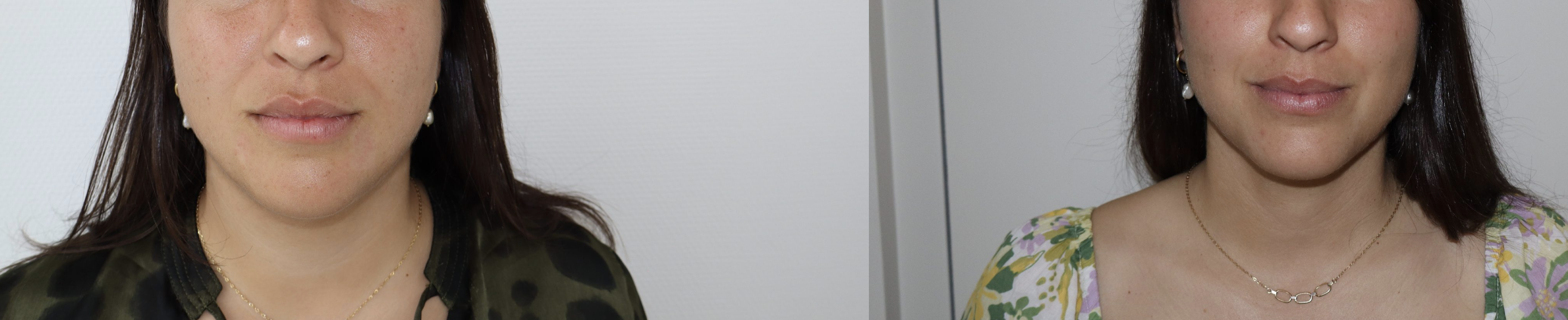 Avant/Après lipoaspiration cervicale